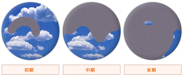 緑内障の症状の進み方[図]